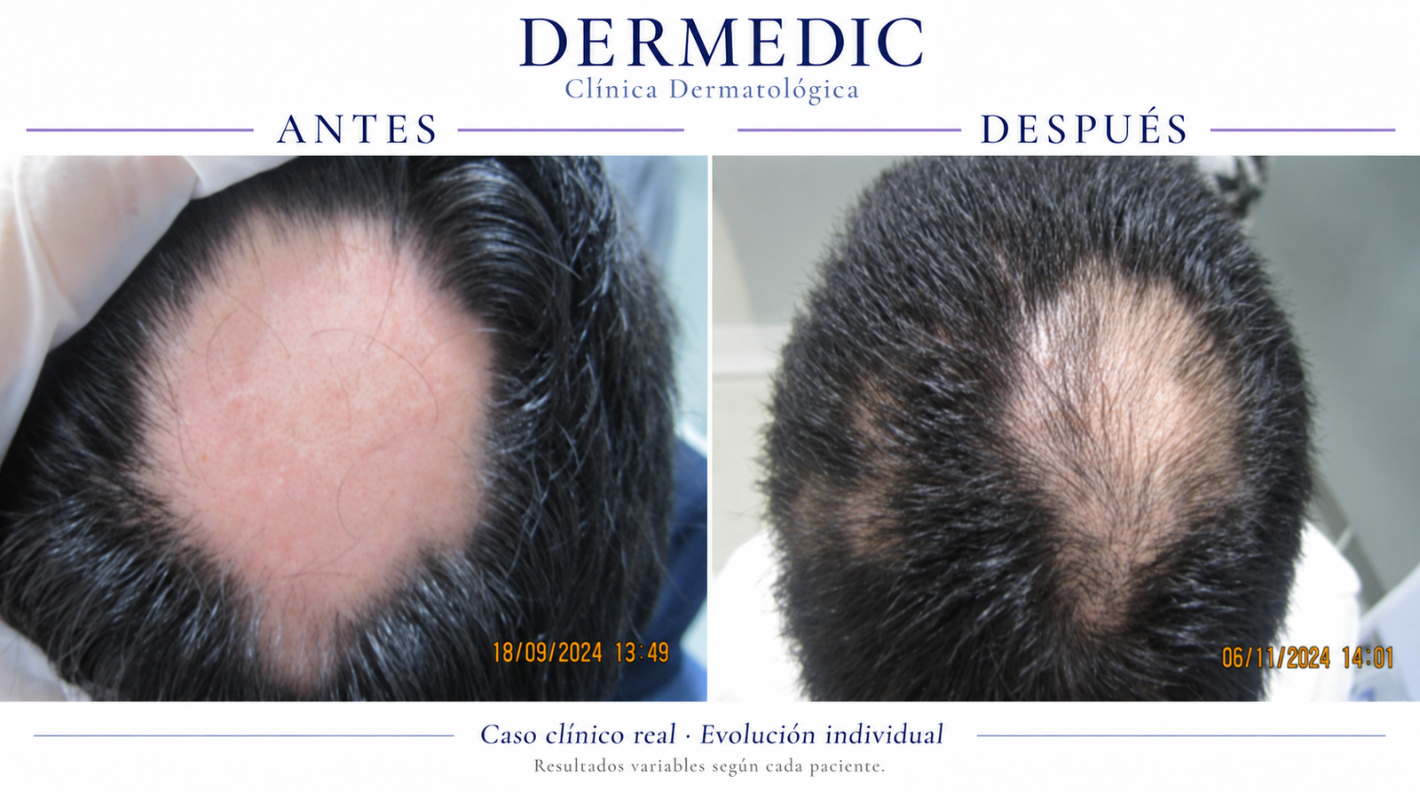 alopecia