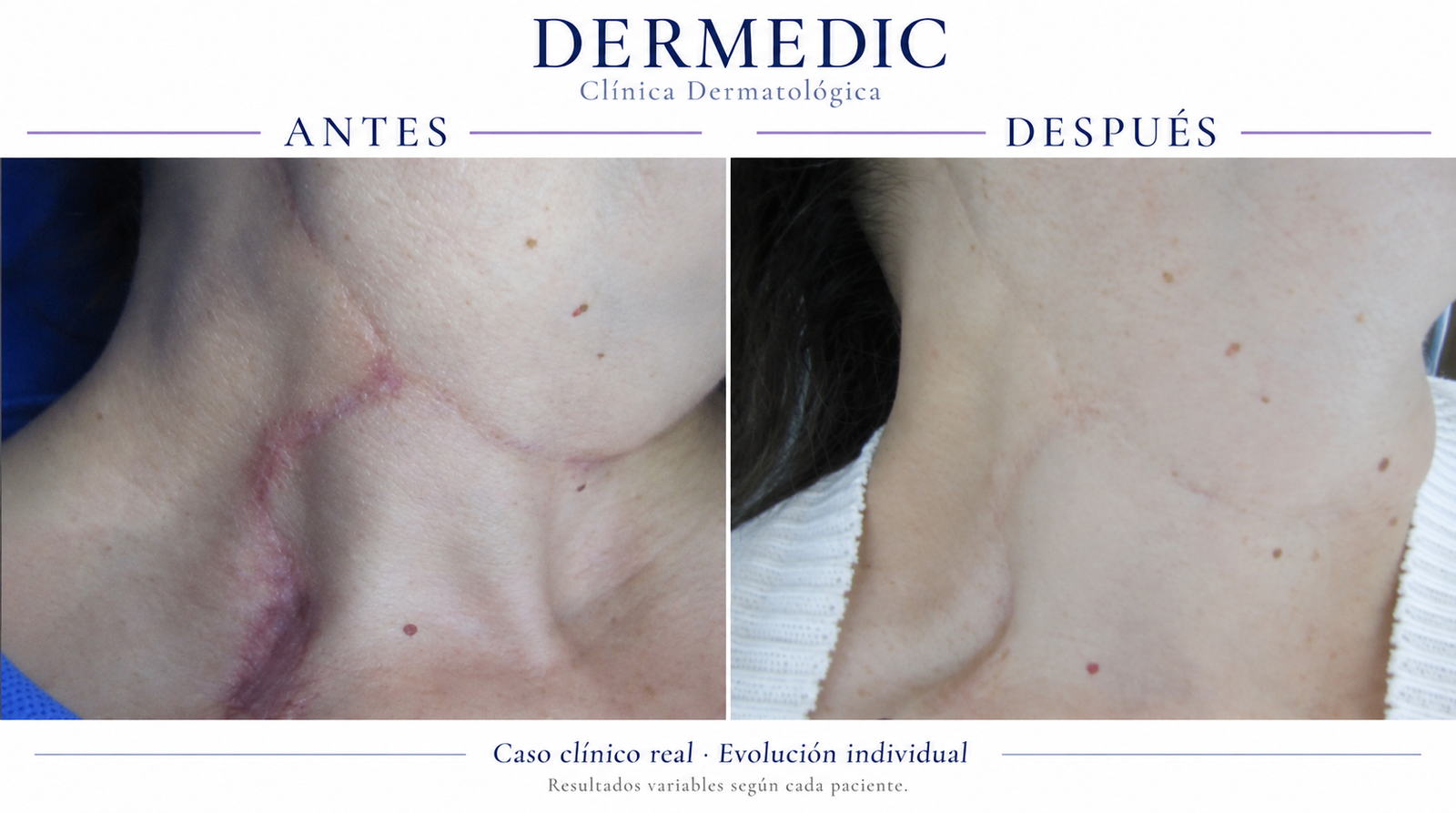 cicatrices