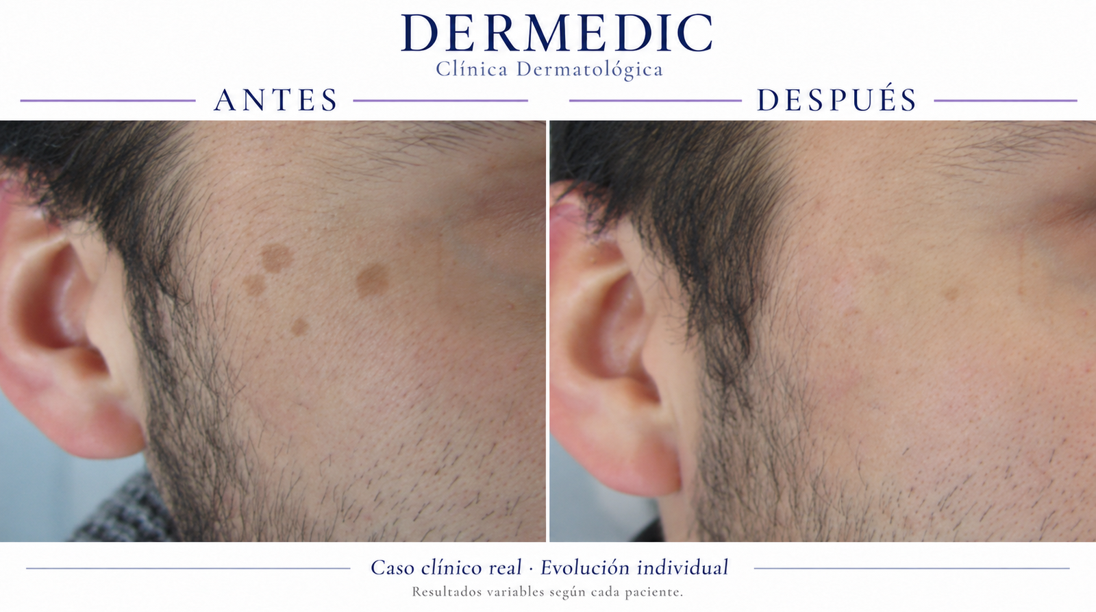 manchas y melasma